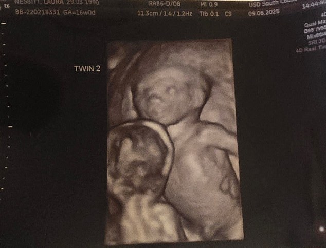 Twin Two (right) is receiving more blood and fluids than Twin One (left)