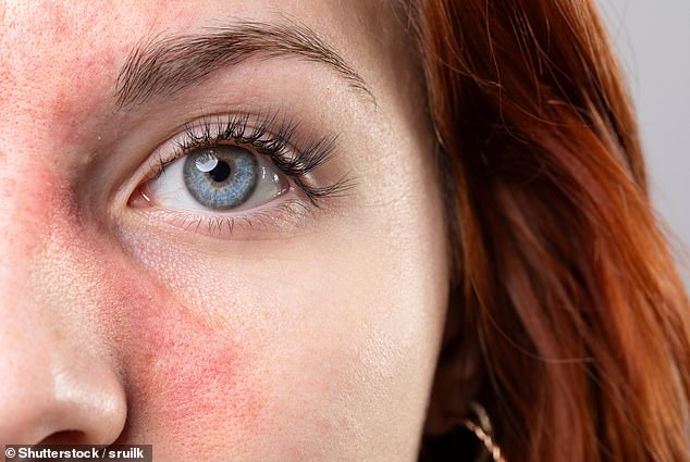 As many as three million people in the UK have rosacea and currently there is no cure