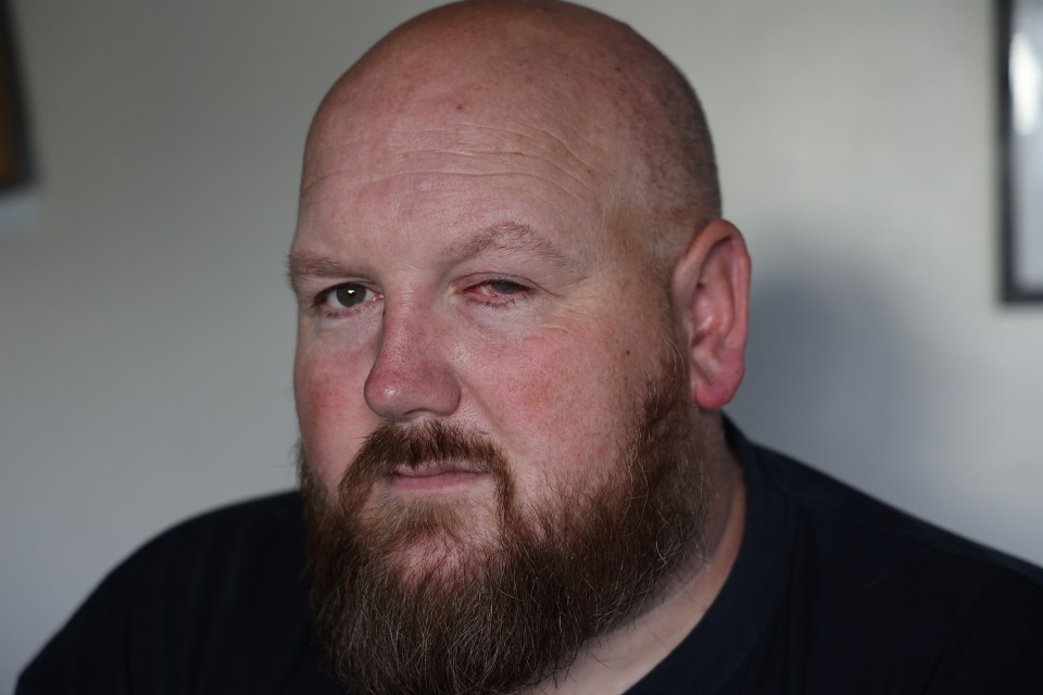 Close-up of Paul Laskey, an acid attack victim.