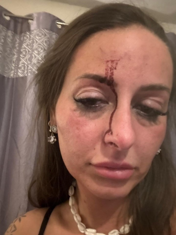 Woman with facial injuries from assault.