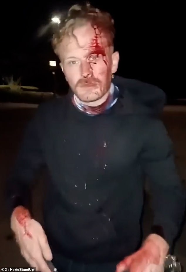 Louis suffered a severe gash and blood streamed down his face after he said he was attacked with 'a glass bottle containing a lit rag'