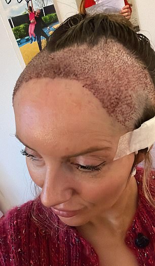 The follicle surgery lasted 11 hours