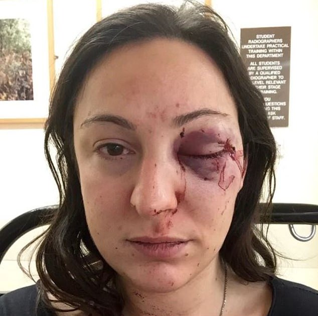 Emilie Martin (pictured, with her injuries after her ordeal), 39, of east London , was shopping at the chain supermarket in the capital's Hackney area in 2015 when the horrifying attack happened