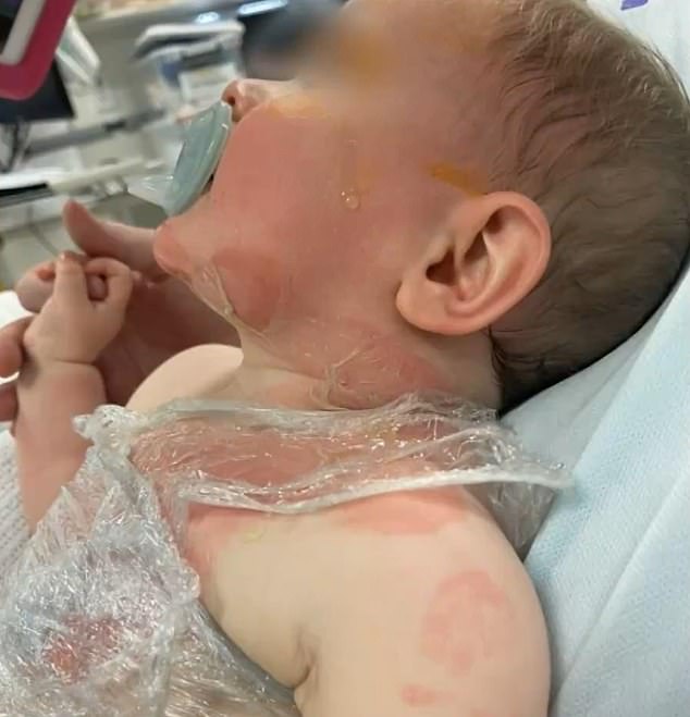 It's been almost a year since baby Luka had hot coffee poured on him by a stranger