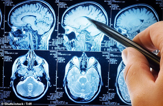 Until now, dementia diagnoses often rely on questionnaires to indicate problems with memory as well as MRI scans (pictured) to track loss of brain volume