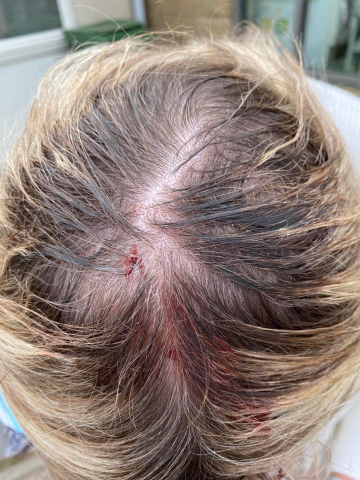 Photo of a woman's head wound after a seagull attack.