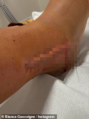 She revealed she had to undergo surgery and was left wearing a cast