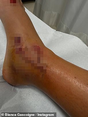 Taking to Instagram on Monday, Bianca shared snaps of her gruesome injury