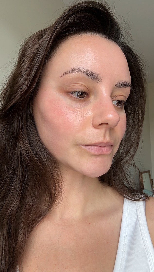 An after photo shows Emma with clear skin. She advises seeing a skin expert or dermatologist to identify the problem and treat it correctly