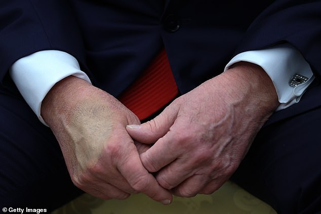 When the President was spotted with heavy makeup on his hand earlier this year, his Press Secretary Karoline Leavitt tried to quash rumours by claiming it was caused by handshakes
