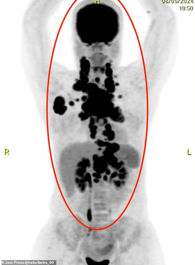 This x-ray shows how tumours were 'crushing' her internal organs