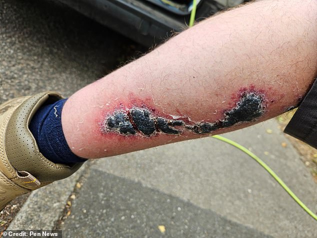 Shortly after, his leg turned black with a huge wound covering the back of his lower legs. Mr Abrehart said it 'hurt to stand up straight'