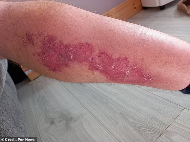 Although the bite looked small to begin with, it began itching and soon a large red area appeared on his leg