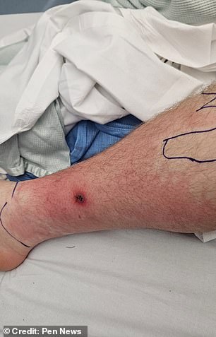 The bite appeared to spread, which prompted Mr Abrehart to go to hospital