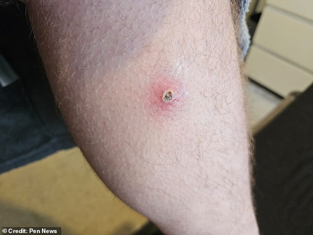 While the bites was only small to begin with, it quickly swelled up and became extremely painful
