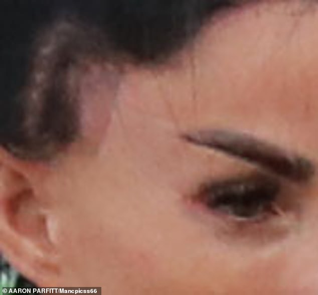 The former glamour model, who recently underwent a sixth face lift, was seen with a painful looking eye injury on the corner of her right eye