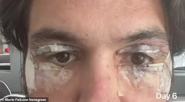 Mario revealed last year that he'd gone under the knife for upper and lower blepharoplasty - surgery on his eyelids