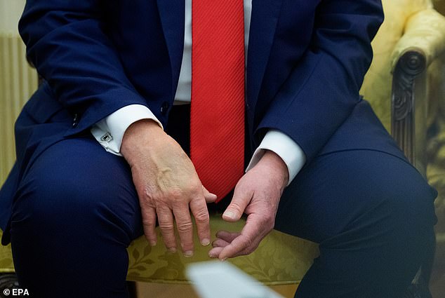 Speculation regarding Trump's health has reached new heights in recent weeks after noticeable bruising to the president's hand