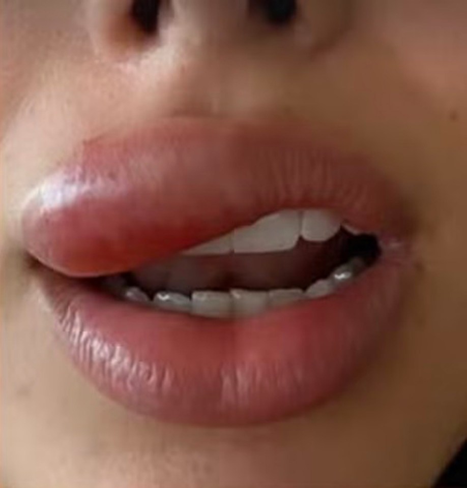 Close-up of Bruna Biancardi's swollen lip.