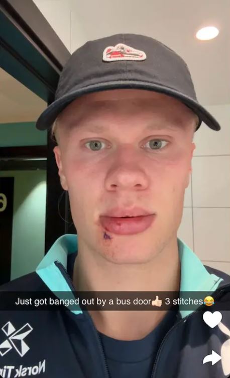 Man with a cut lip after being hit by a luggage door.