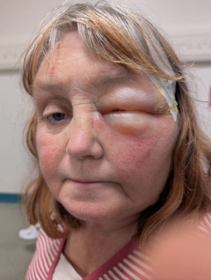 Close-up photo of a woman's face with burns and swelling around her eye.