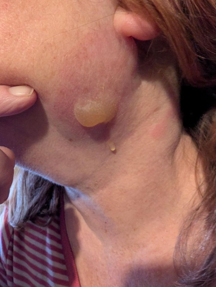 Close-up of a burn on a woman's face.