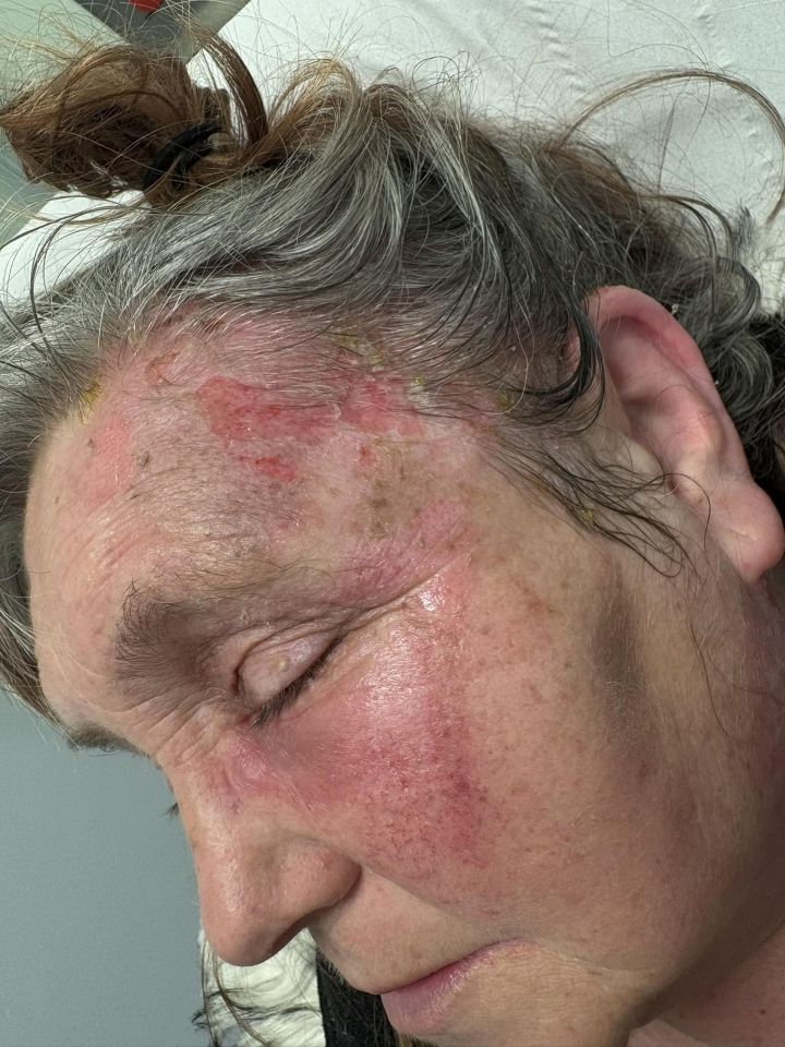 Close-up of a woman's face with burns on her forehead, face, and ears.