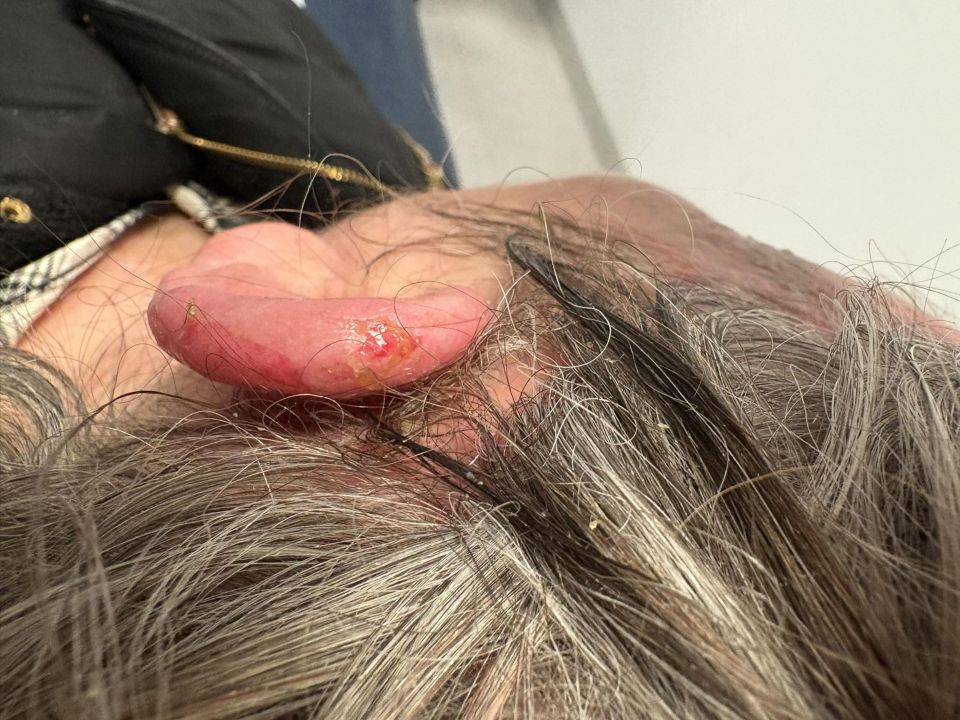 Close-up of burns on a woman's ear and head.