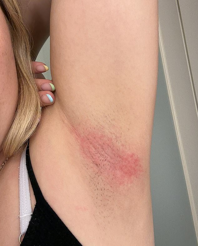 Some users were left with an angry red rash
