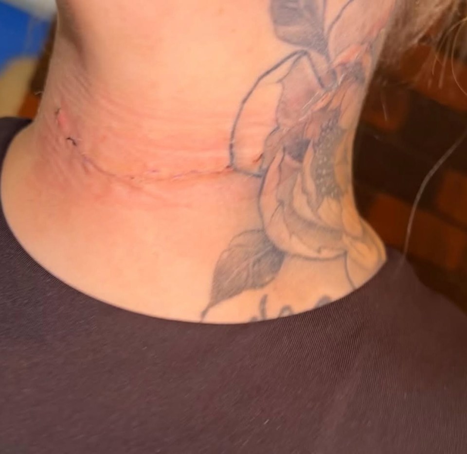 Neck scar following thyroid surgery.