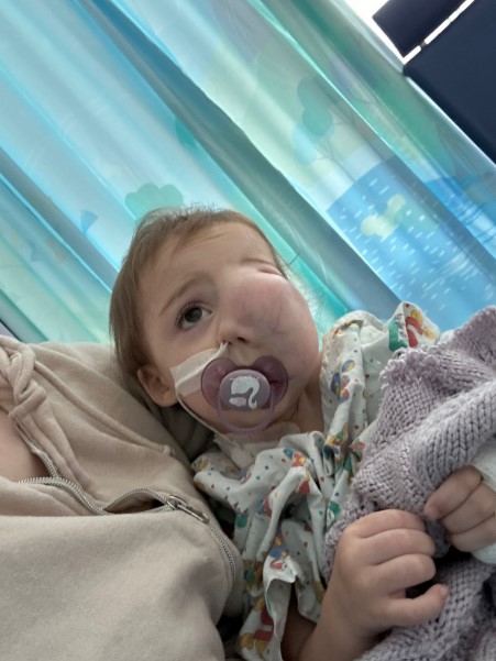 Toddler with swollen face in hospital bed.