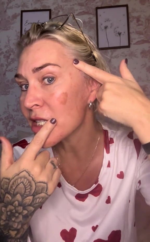 Jo O'Meara from S Club 7 showing off adult acne on her face.