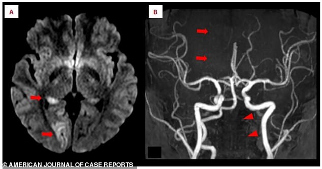 Doctors discovered she had suffered a stroke. Panel A arrows point to bright white spots on the brain scan (the MRI) showing the acute ischemic stroke in the right occipital lobe. Panel B upper arrows point to a missing section of the normally visible, smooth line of the right posterior cerebral artery, indicating the blockage that caused the stroke. Lower arrows are pointing to the left vertebral artery in the neck, which appears faint or broken