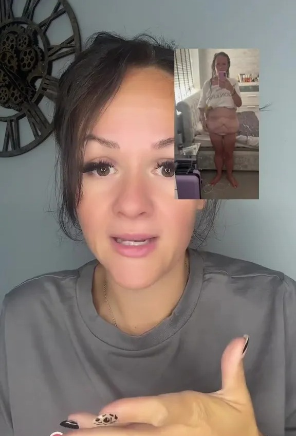 A woman explaining the effects of losing 32% of her body weight, with an inset picture showing her loose skin around her midsection.