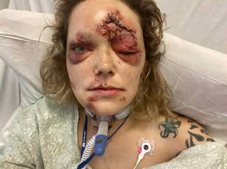 Savanah White in a hospital bed with significant facial injuries, including bruising, swelling, and lacerations, with medical tubing around her neck.