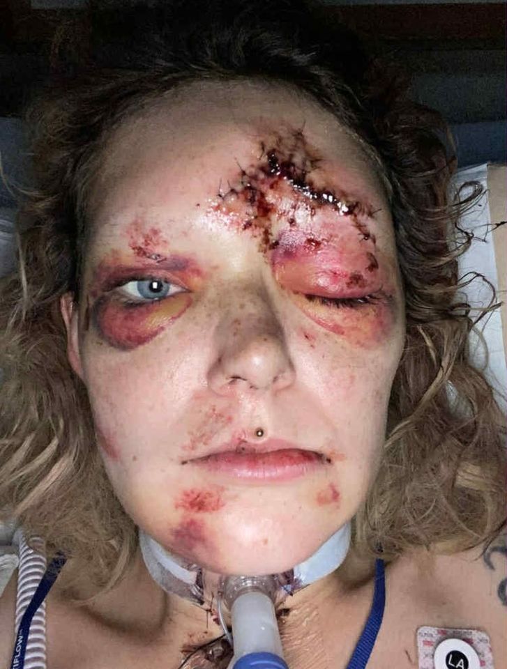 Savanah White in a hospital after an e-scooter accident, with a large, stitched wound on her forehead and severe bruising around her eyes.