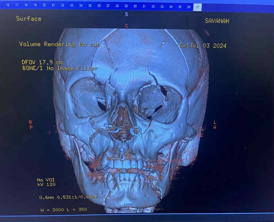 X-ray image of a skull fracture belonging to Savanah.