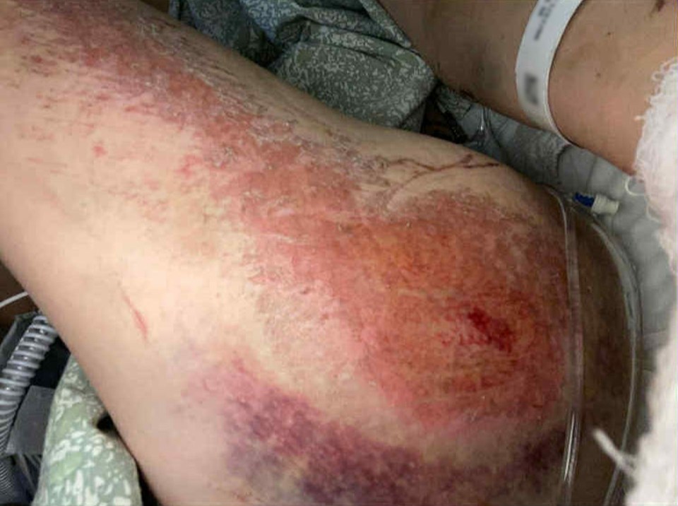 Savanah White's leg bruises, scrapes, and abrasions after an e-scooter accident.