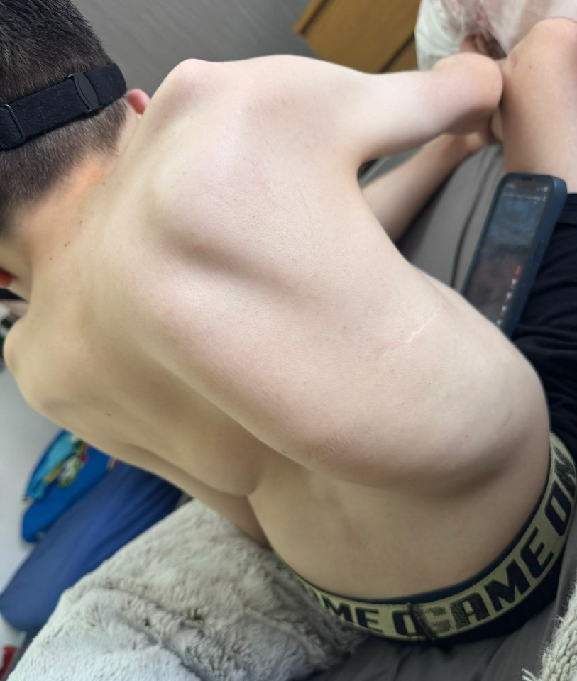 The back of a person with a visible spinal curvature and a scar on their left shoulder blade.