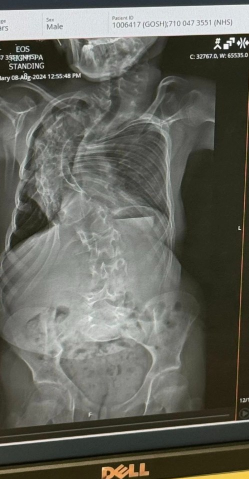 An X-ray of a male patient's spine, showing a severe spinal deformity.