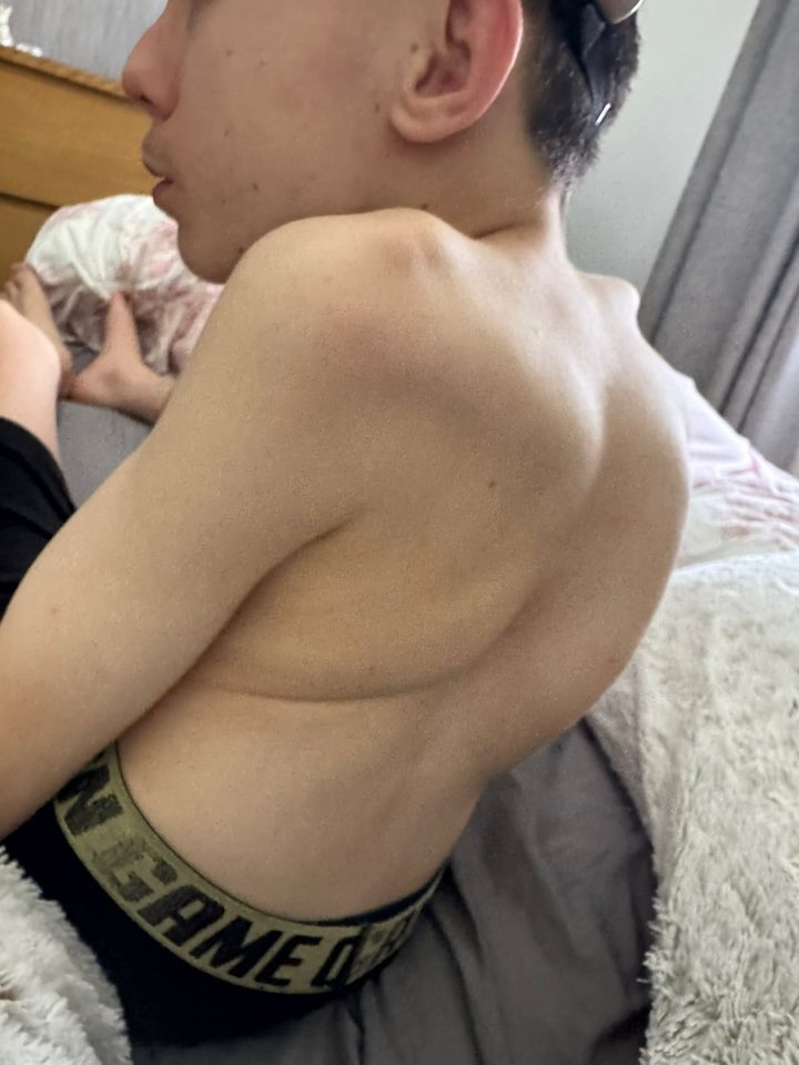 The back of a boy with a severely curved spine.
