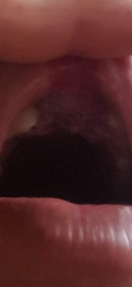 Close-up of a woman's mouth showing severe dental damage.