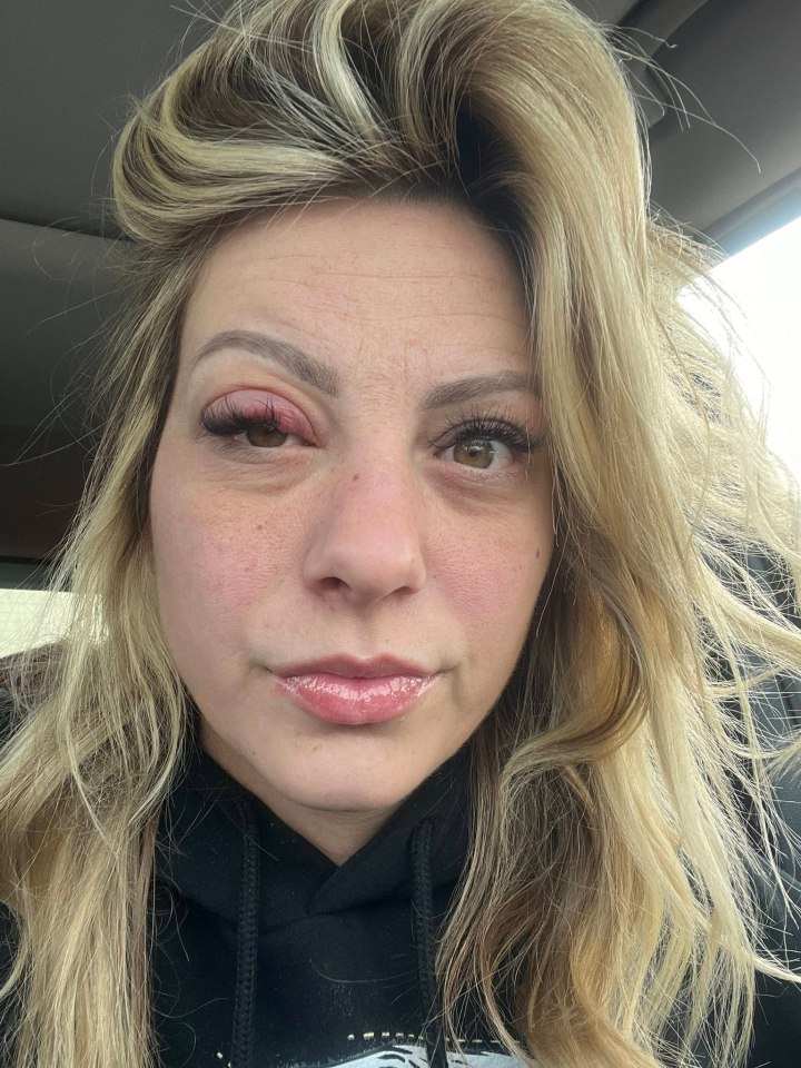 A woman with blond hair looks at the camera with her right eye swollen shut.