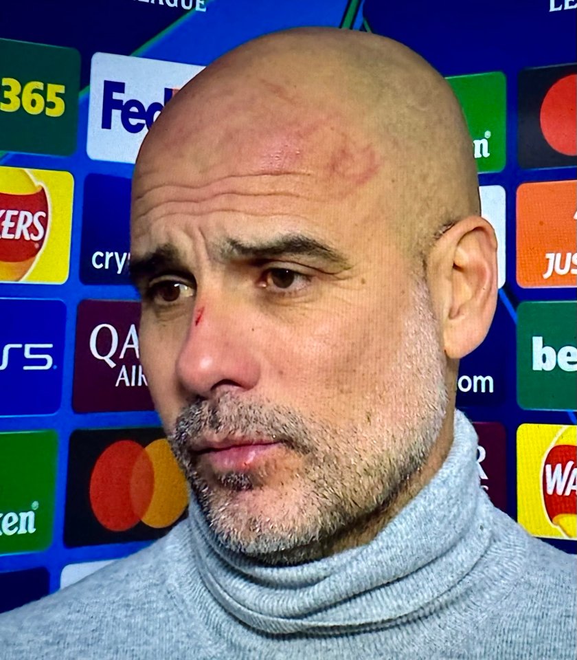 Pep Guardiola with a scratched head and a cut on his nose and lip.