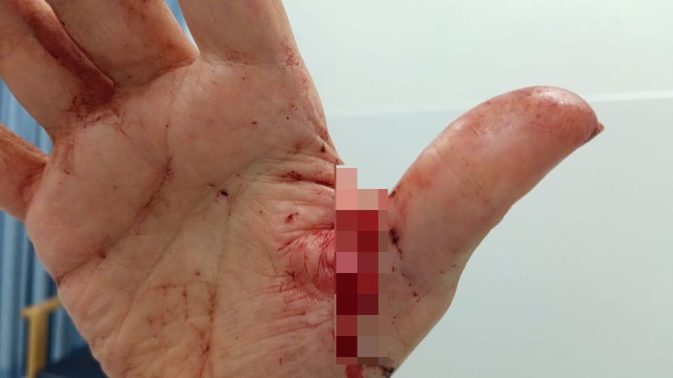Hand of a person with a wound on the palm and thumb, inflicted by Shane Berry.