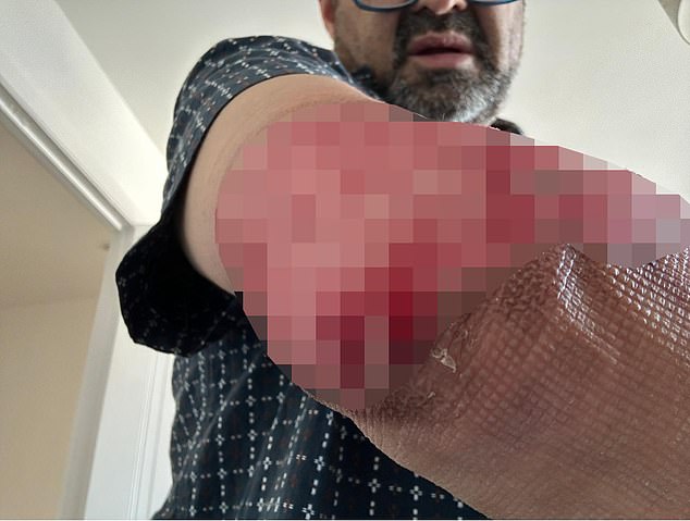Nick Palit, 60, a veteran BBC presenter who fronted BBC Wales Today, with severe burns on his arm