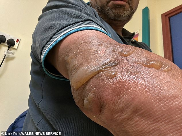 Nick's arm is pictured severely blistered after the blaze which destroyed the couple's house