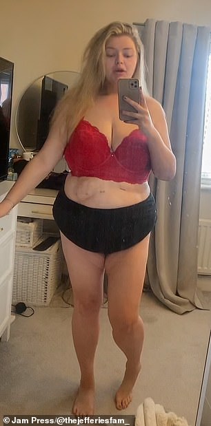 Mrs Jeffries before she had skin removal surgery in Turkey