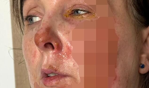 Angela is seen with horrific burns covering her face after the incident which saw an environmentally friendly fire device explode