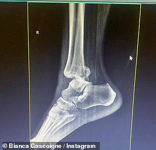Bianca also shared snaps of her stitches and X-rays